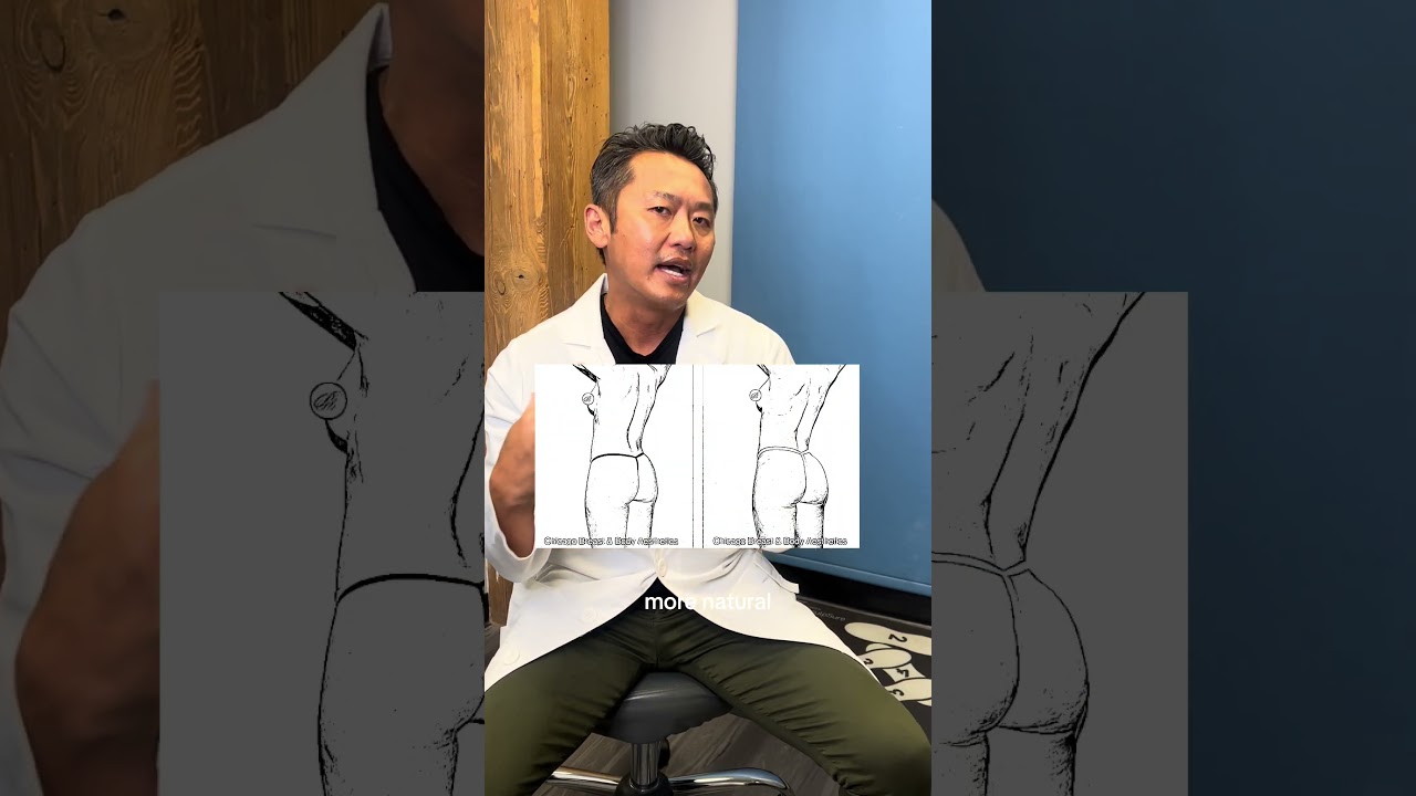 The 3 Different BBL Shapes!!! #bbl2023 #bbl #bblsurgery #bblsquad #plasticsurgerybeforeandafter