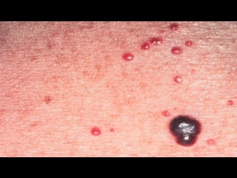 DermTV - What Are Cherry Hemangiomas [DermTV.com Epi #340]