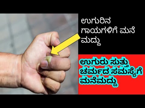 finger infections  home remedy Kannada l ಉಗುರಿನ ಗಾಯಗಳಿಗೆ ಮನೆ ಮದ್ದು l skin infections remedy l