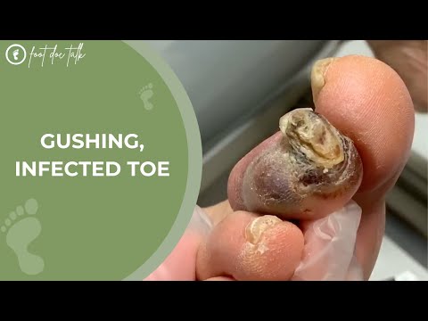 Gushing, Infected Toe