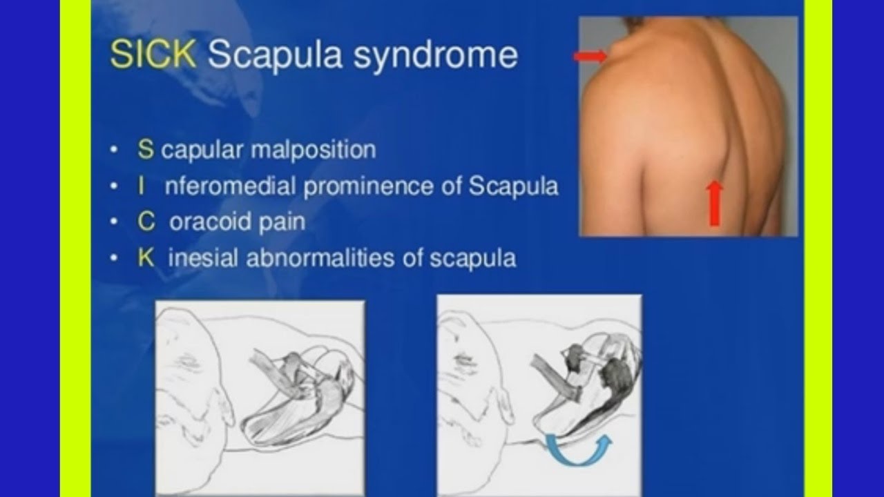 A C Joint Injuries  (Acute form)  Treatment Approach.