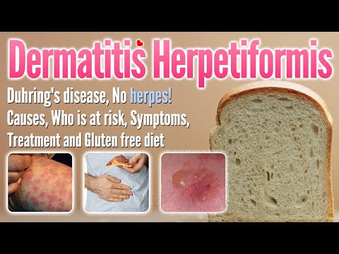 Dermatitis herpetiformis Causes, Symptoms, Treatment and gluten-free diet list | Duhring’s disease