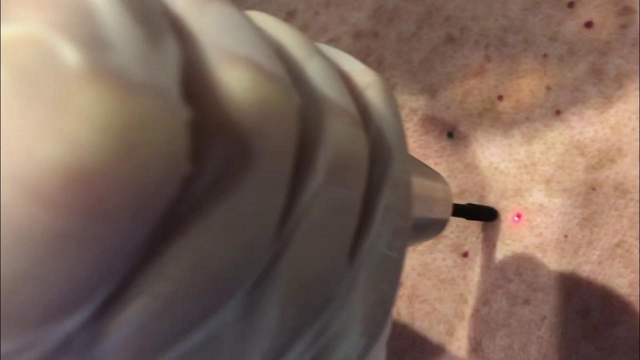 Cherry Angioma Removal YouTube