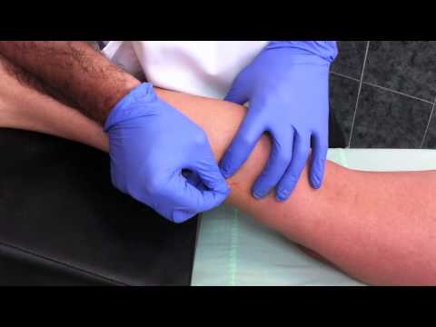 Punción seca del músculo gemelo interno. Dry needling