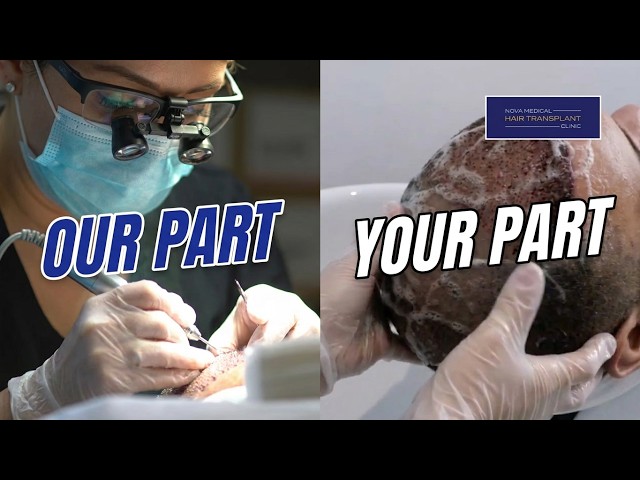 Your Hair Transplant Results Are Not Just Up to Us - The Honest Truth | Nova Medical Hair Transplant