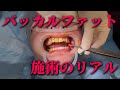 【顔の頬をシュッとしたい!】バッカルファット除去の施術風景を大公開します!