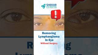 Lymphangioma, A Condition Where Abnormal Blood Vessels Grow Within The Eye Socket