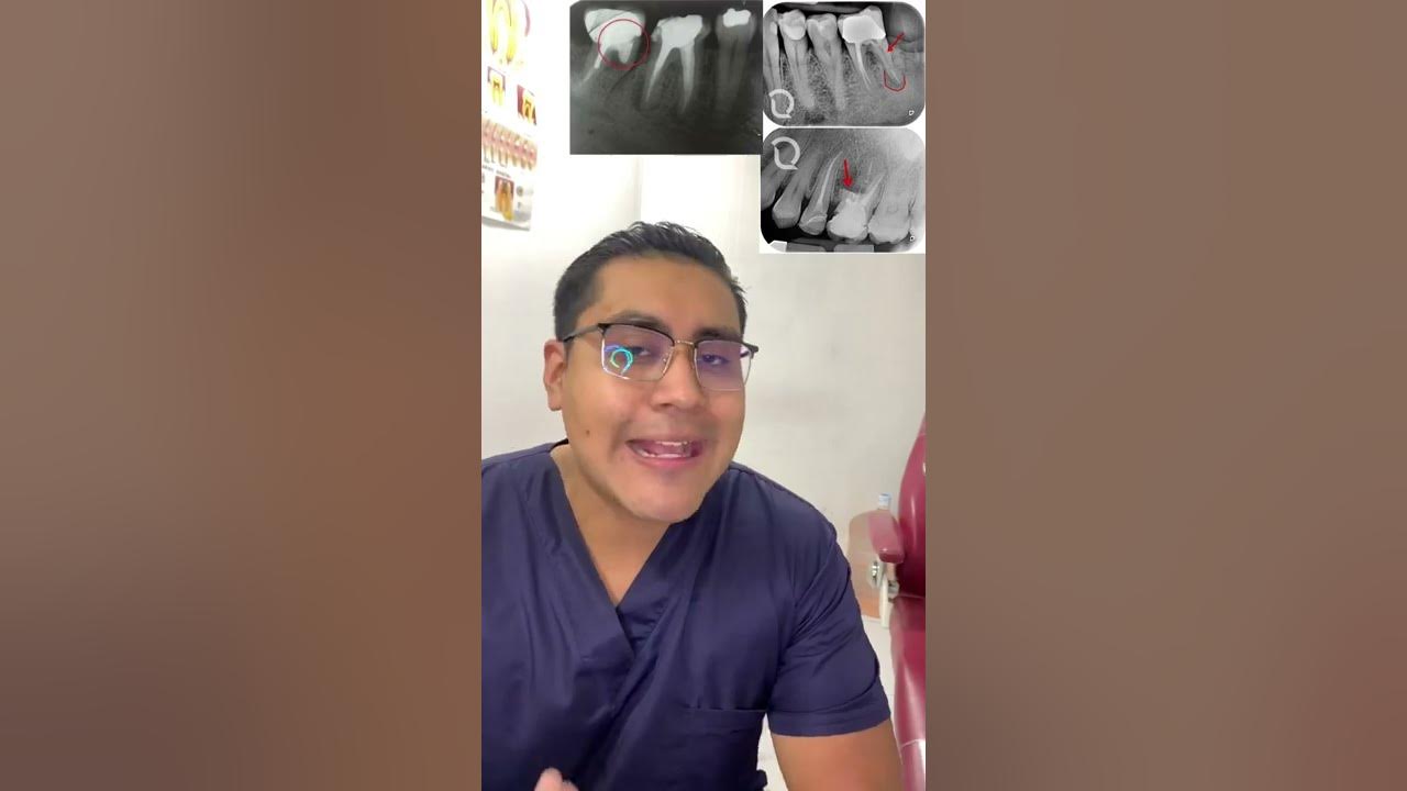 Cuanto tiempo se tarda en hacer una endodoncia