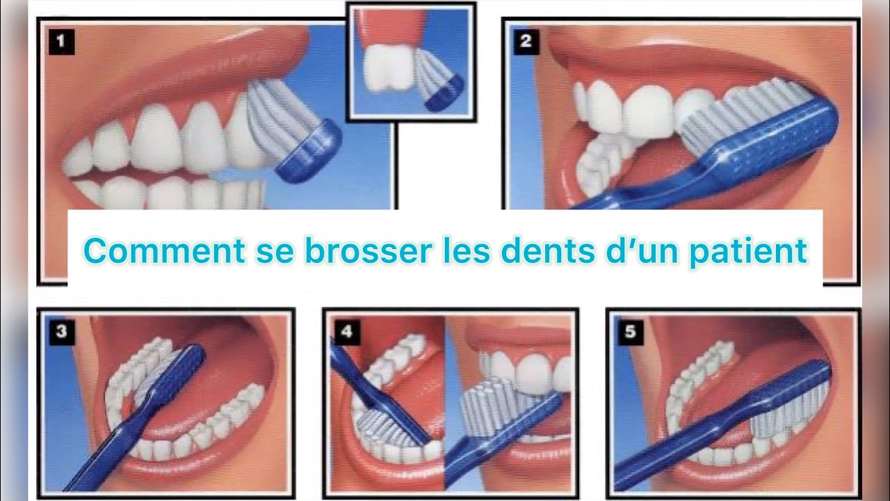 Comment se brosser les dents d'un Patient YouTube