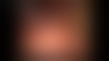 Laparoscopic - Robotic "COMPLETE MESOGASTRIC EXCISION" FOR LOCALLY ADVANCED GASTRIC CANCER