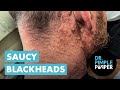 Saucy Blackheads