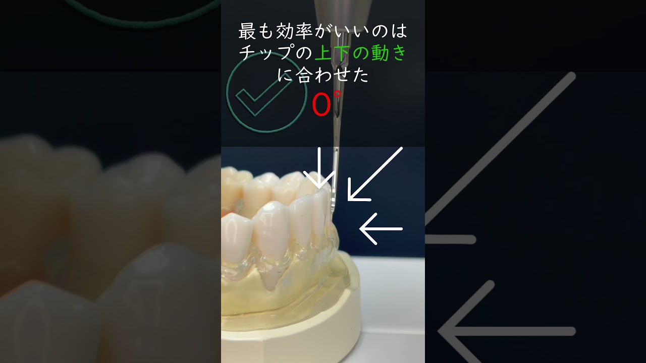 なぜ超音波チップは歯面に0〜15度で当てるのか?0度で当てると良い理由