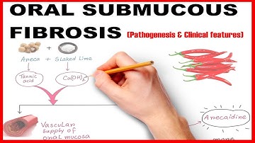 Oral Submucous Fibrosis (OSMF) :  Pathogenesis and Clinical Features