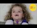 The Girl Born Without a Nose (BAM Syndrome)