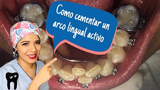 ¿COMO CEMENTAR UN ARCO LINGUAL ACTIVO?