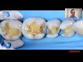 Creating Interproximal Contacts with Direct Restorations Presented by Javier Quirós, DDS