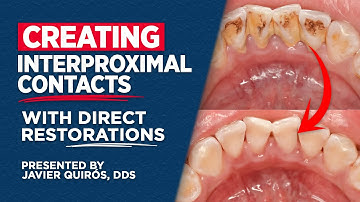 Creating Interproximal Contacts with Direct Restorations Presented by Javier Quirós, DDS