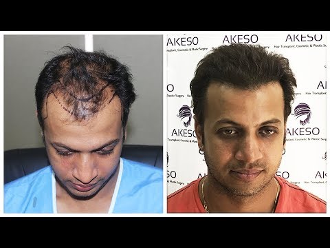 Mr. VIKAS -AKESO HAIR TRANSPLANT REVIEW. BEST HAIR TRANSPLANT IN DELHI ,  INDIA - YouTube