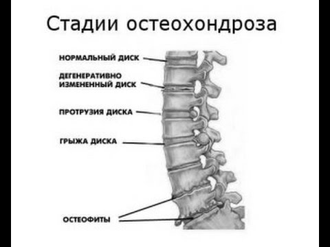 Остеохондроз какие степени