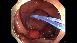 Resection of 4 pedunculated polyps. Unedited video demonstration.