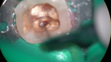 18246 removal of a non visible broken file beyond the curve