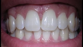اقوى وصفة لتبييض الاسنان و تحويلها الى الماس في 3 دقائق هذه هي الوصفة اللتي استعملها لتبييض اسناني