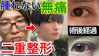 二重整形 一重ブスが埋没法で全く腫れずに大イメチェン ダウンタイム経過 Youtube