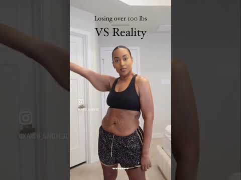 Loose Skin After Vsg Surgery Vsg Weightloss