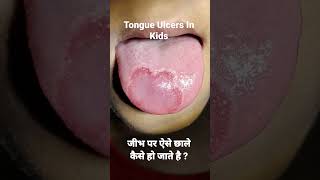 जभ पर ऐस छल कस ह जत ह? Tongue Ulcers In Kids