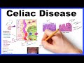 Celiac disease - Pathophysiology, Symptoms, Histology, Diagnosis & Management