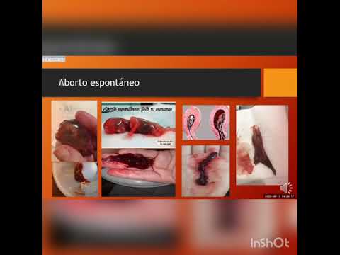 Video: ¿Cuál es la diferencia entre aborto perdido y aborto incompleto?