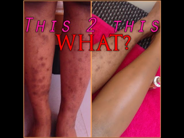 Scarred legs? Fear no more! {tutorial} 