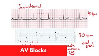 ECG Basics | AV Blocks | For DO, MD, NP, PA [Part 4]