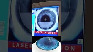I Filmed My Lasik Eye Surgery So I Could See It