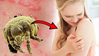 How To Get Rid of Scabies at Home (NATURAL HOME REMEDY)