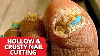 Cutting and Debridement On HOLLOW, CRUSTY Nails!