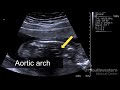 Understanding your fetal ultrasound