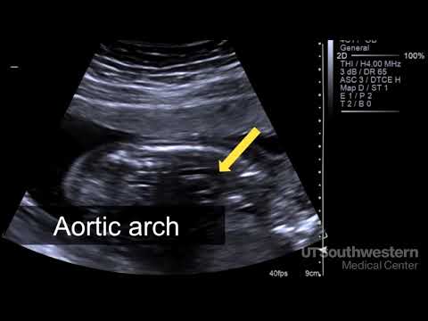 Video: Hur kan du avgöra om det är en pojke eller flicka från en ultraljudsbild?