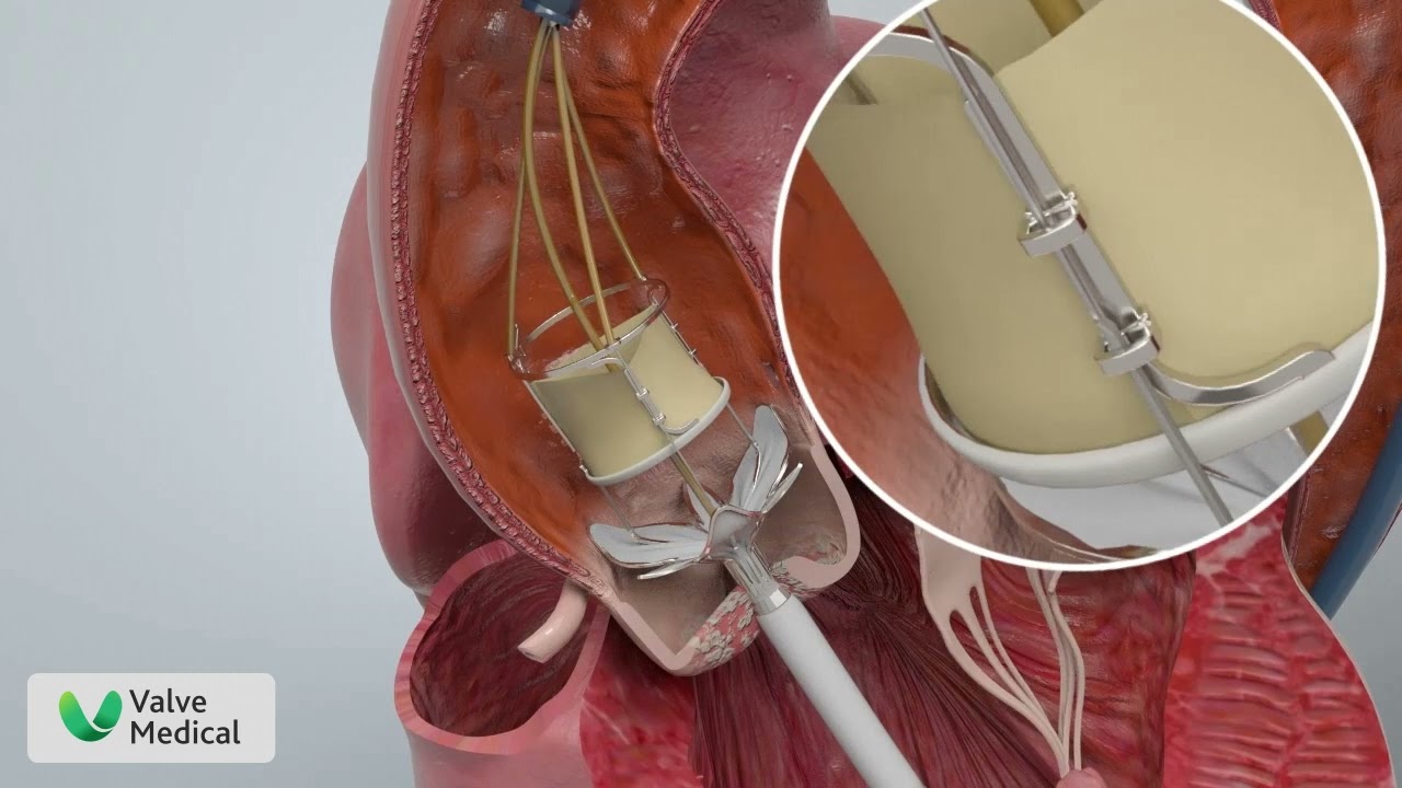Valve Medical's Aortic Valve Replacement Animation