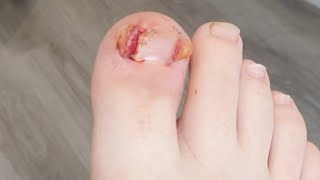 Bye Bye Ingrowing Toenail 👋