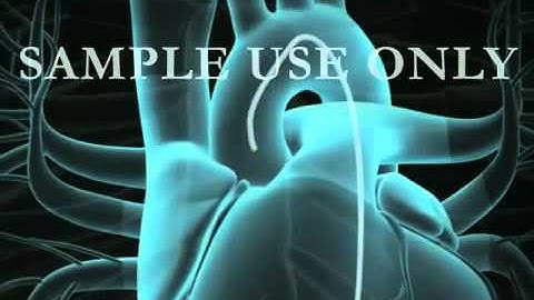 Coronary Artery Angioplasty  (PCI, Heart Stent Surgery)