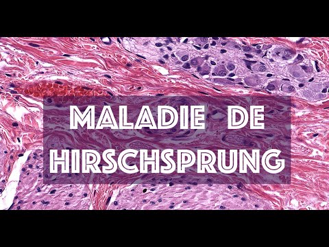 Vidéo: Expressions Aberrantes UBR4 Chez Les Patients Atteints De La Maladie De Hirschsprung