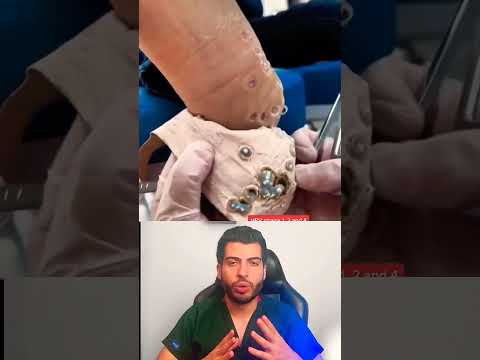 التآليل ومسمار القدم فيروس الفيروسات Hpv مسمار القدم مسمار اللحم د مصعب حسوا ثقف نفسك طبيا