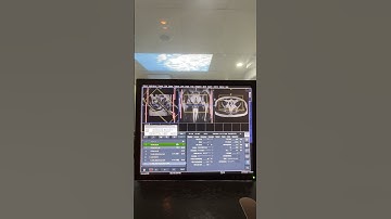 RM de pelve para fístula igual você nunca viu!