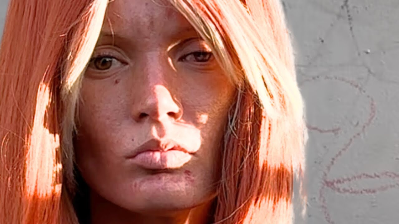 Angelina 32 Left Eye Blind Limping Hit By Car