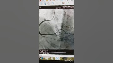 Angioplasty/ RCA/ 👍 #medical #doctor #pci #shorts #angiologista #hospital