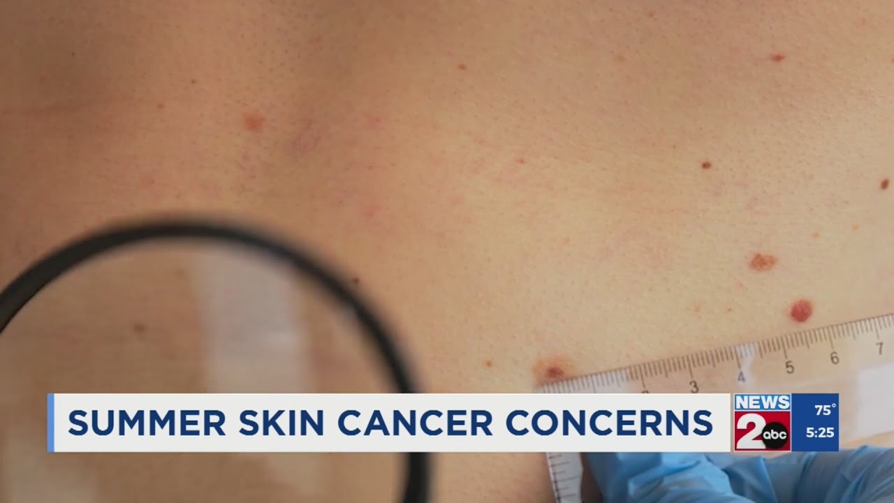 Summer skin cancer concerns