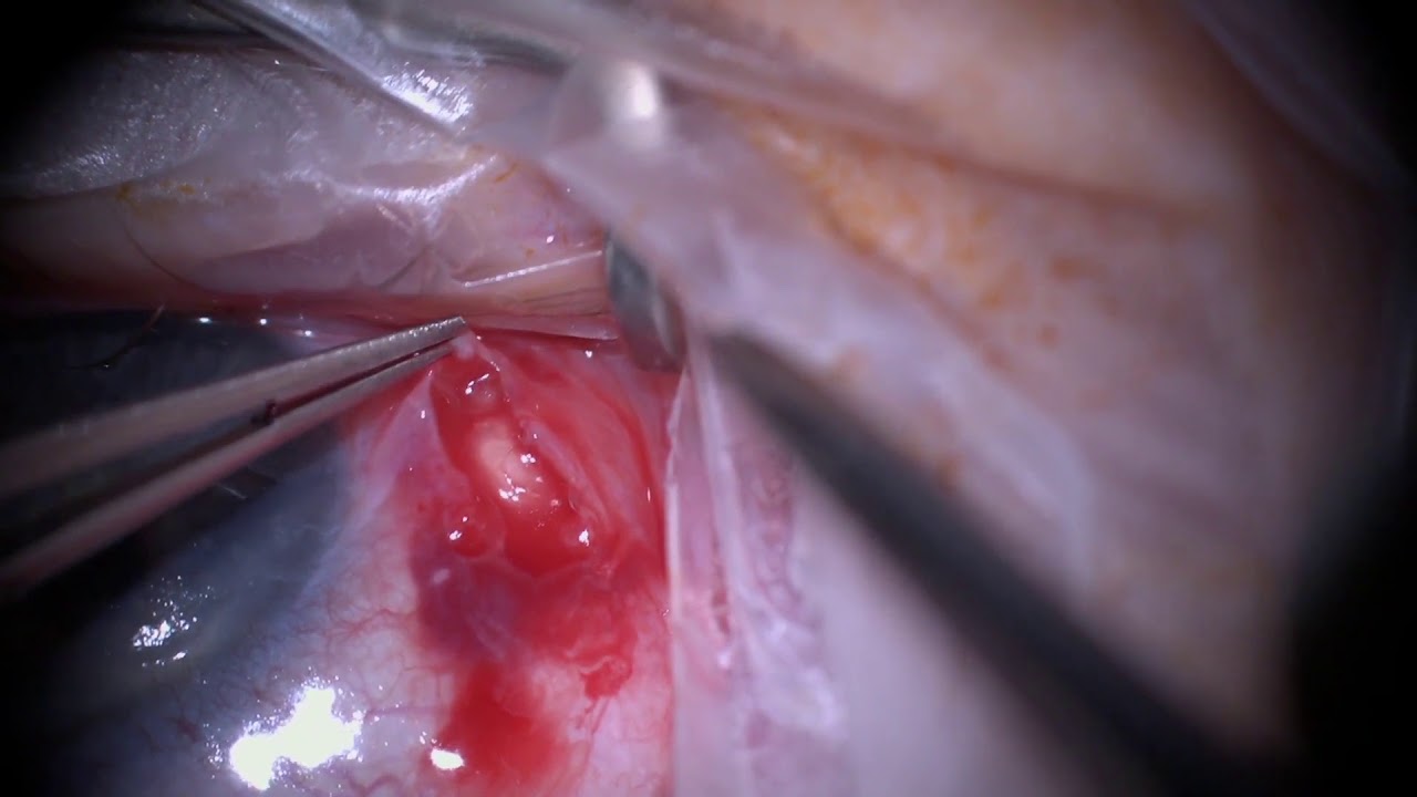 Операция: удаление конъюнктивальной кисты