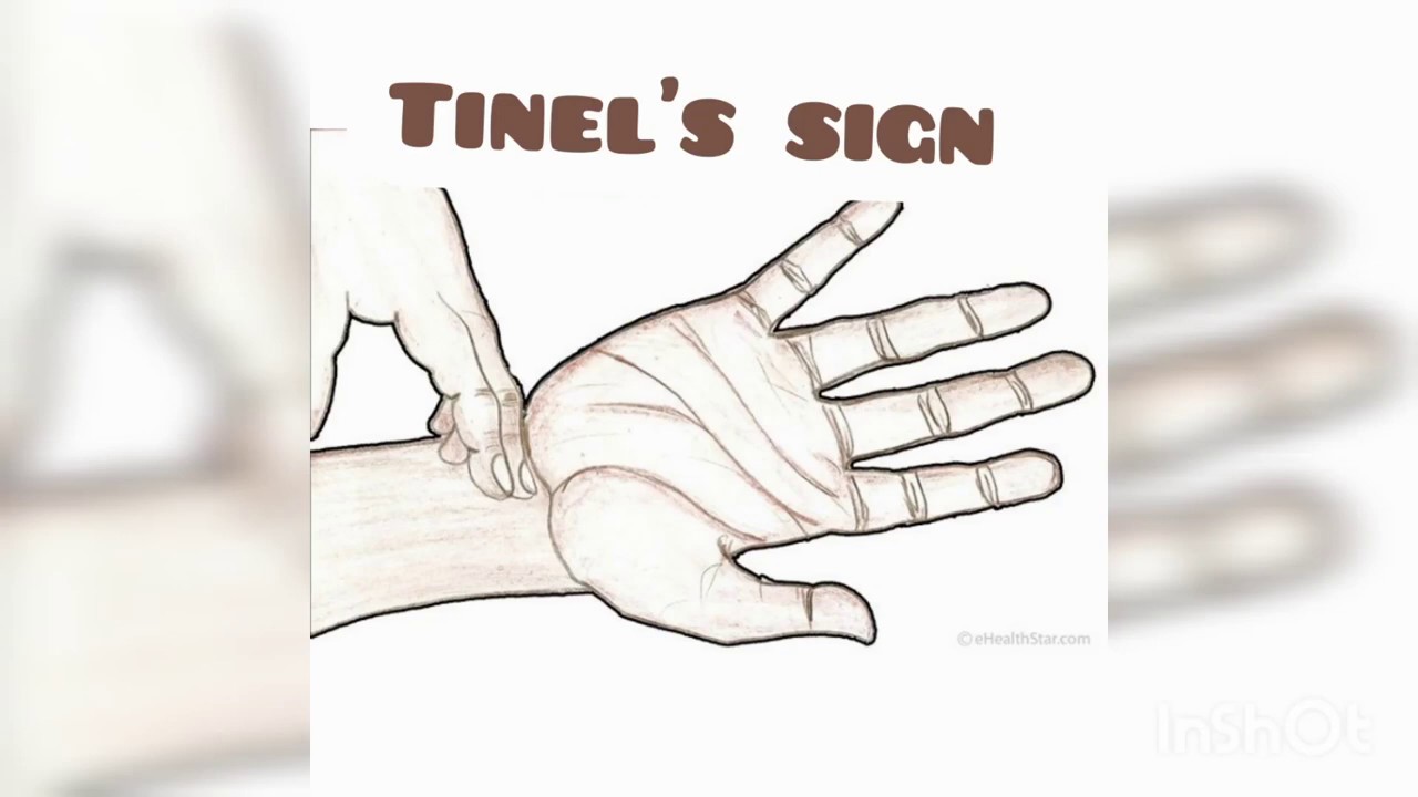 Tinel's Sign Wrist Carpel Tunnel Syndrome YouTube