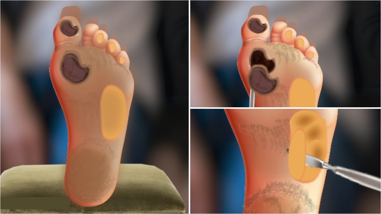 ASMR Animation Cracked Feet Treatment | Remove Plantar Warts, Calluses, Corn | Foot Deep Cleaning